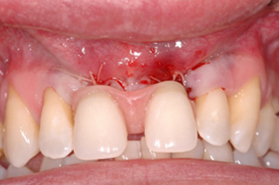 Estrazione denti con applicazione protesi