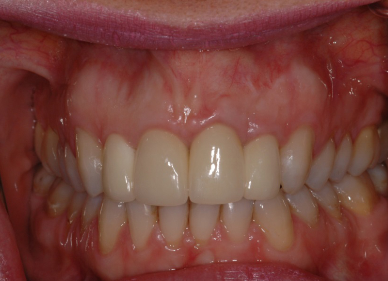 Risultato Finale corone in zirconia ceramica