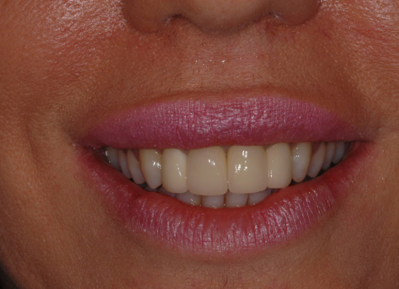 Risultato Finale corone in zirconia ceramica