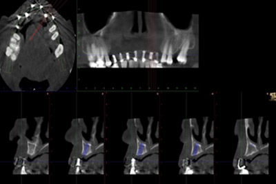Controllo radiografico della situazione dello spessore osseo in corrispondenza dei reperi della placca guida.