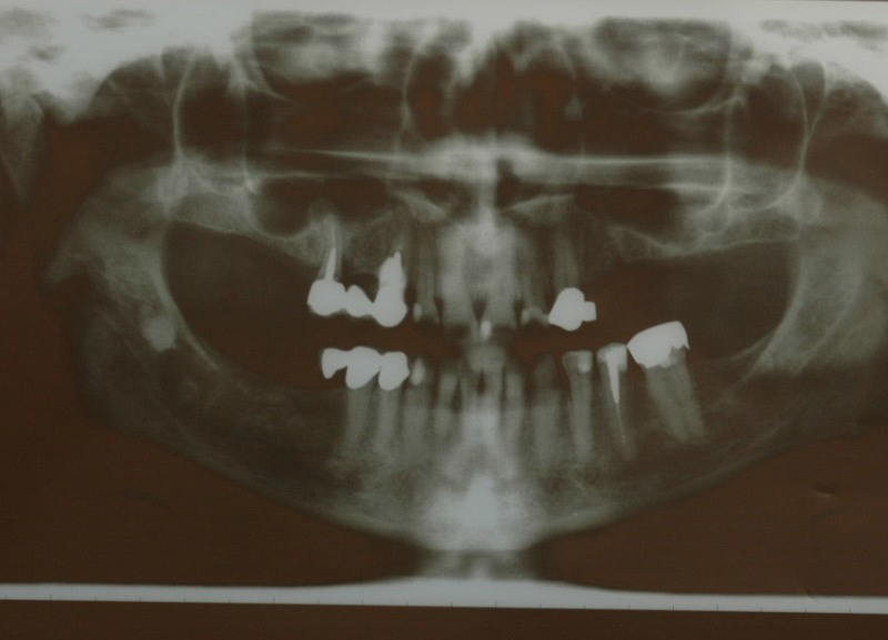 Radiografia prima del trattamento