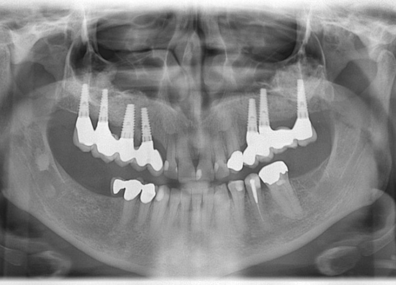 Controllo radiografico finale