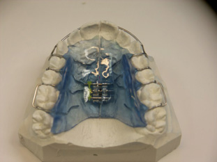 Ortodontici rimovibili