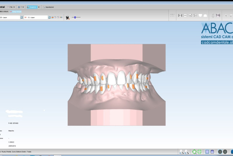 Visione al CAD di setup ortodontico